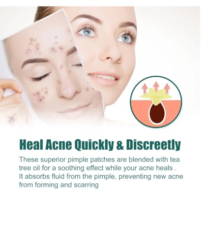 160-Count Hydrocolloid Acne Patches for All Skin Types – Fast-Acting with Tea Tree Oil – 4 Color Set (White, Blue, Purpl