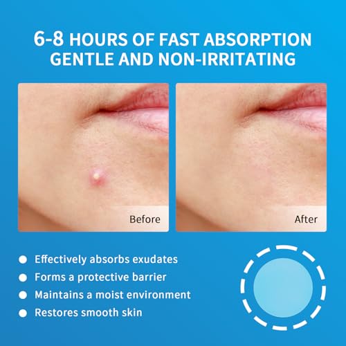 Face Invisible Zit Stickers 216 Count Hydrocolloid Acne Patches
| Hydrocolloid Acne Patches for Face 3 Size Invisible S